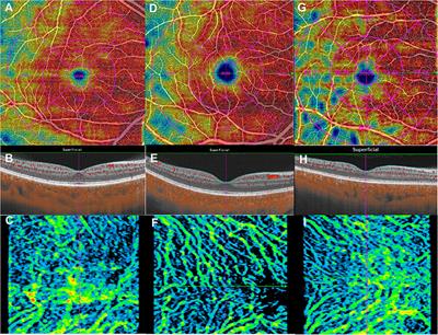 Macular Changes Observed on Optical Coherence Tomography Angiography in Patients Infected With Human Immunodeficiency Virus Without Infectious Retinopathy